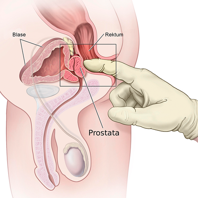 Prostata-Grafik