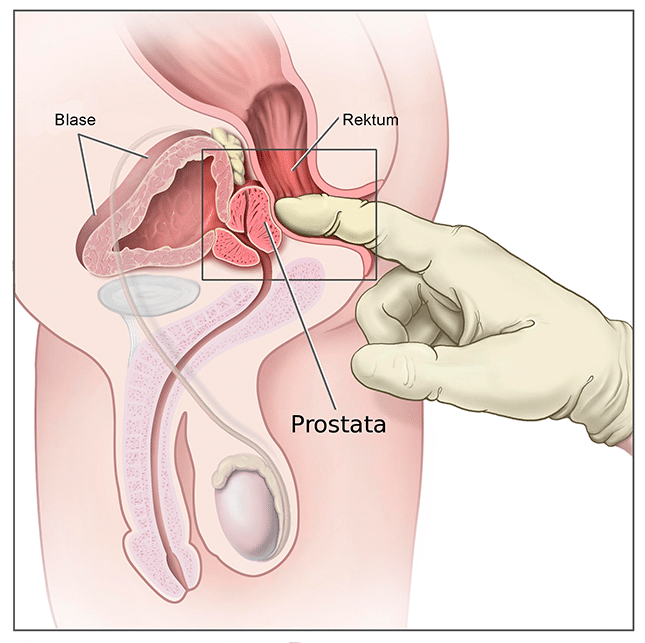 Prostata Untersuchung